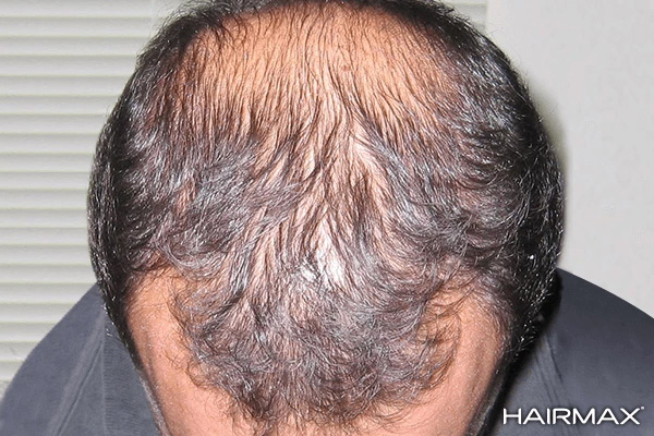 HairMax公式サイト｜髪の悩みにレーザー育毛のヘアマックス
