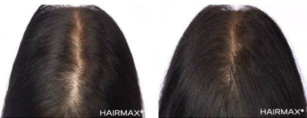 HairMax Japan