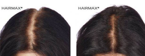 HairMax Japan