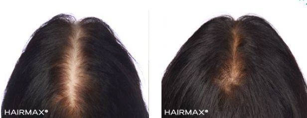 HairMax Japan