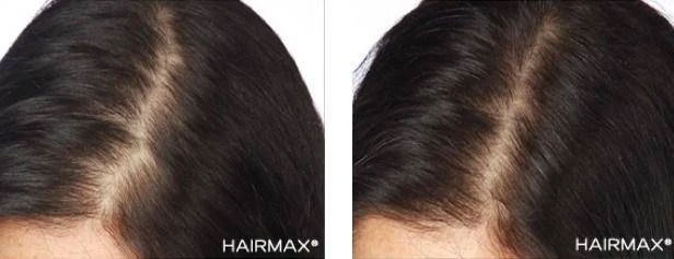 HairMax Japan