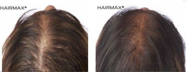 HairMax Japan