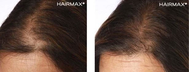 HairMax Japan