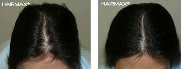 HairMax Japan