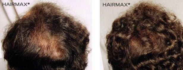 HairMax Japan