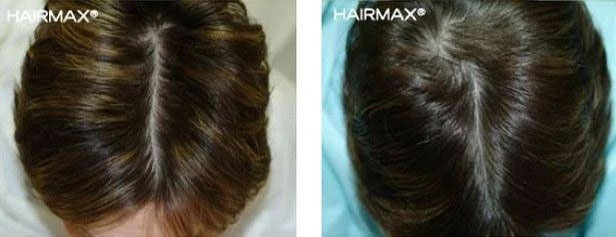 HairMax Japan