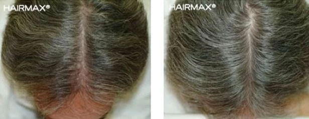 HairMax Japan