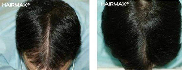 HairMax Japan