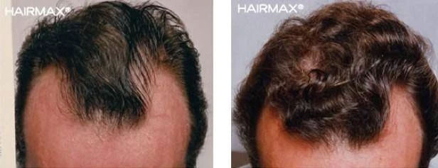 HairMax Japan